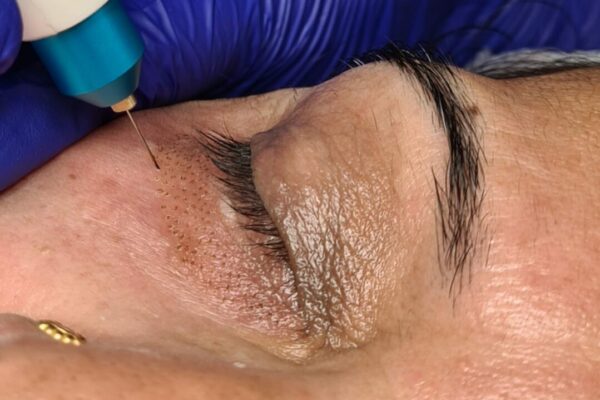 Blépharoplastie non invasive